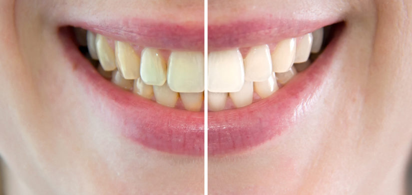 Denti prima e dopo sbiancamento
